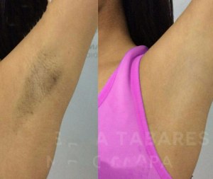 Diode laser d'épilation machine 755 808 1064nm