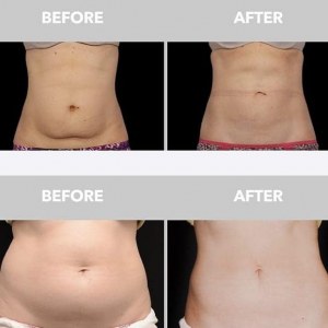 EM SLIM d'amincissement et entraînement musculaire machine