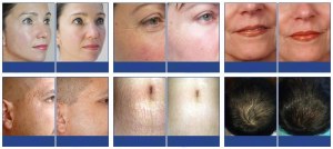 DERMA ROLLER SCS3in1