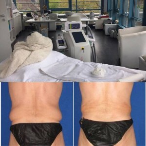 FDA approuvé technologie Cryolipolisis système d'amincissement coolplas