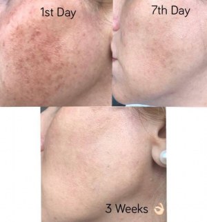 Lumière pulsée IPL d'épilation et rajeunissement cutané