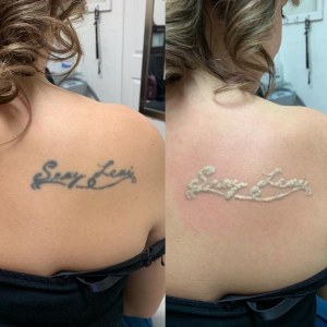 Q-Switched ND yag machine pour relèvement des pigmentations