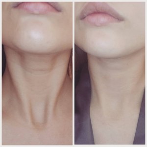 Patchs anti-âge en silicone médical n'utilisant aucun principe actif