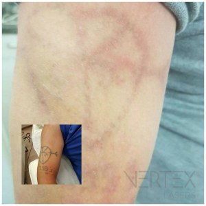 Q-Switched ND yag machine pour relèvement des pigmentations